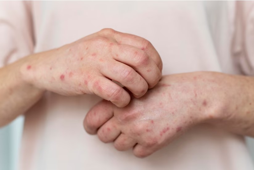 Causas de la aparición de dermatitis en manos